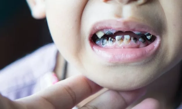 Lack of Fluoride Risks Poor Dental Health for Local Children